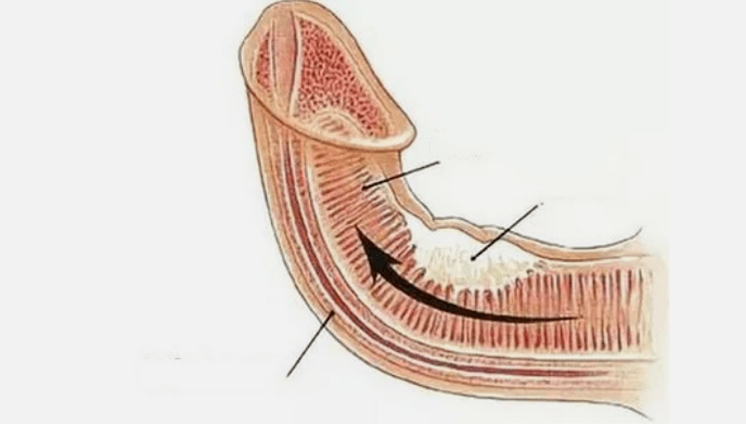 Elimination of venous drain